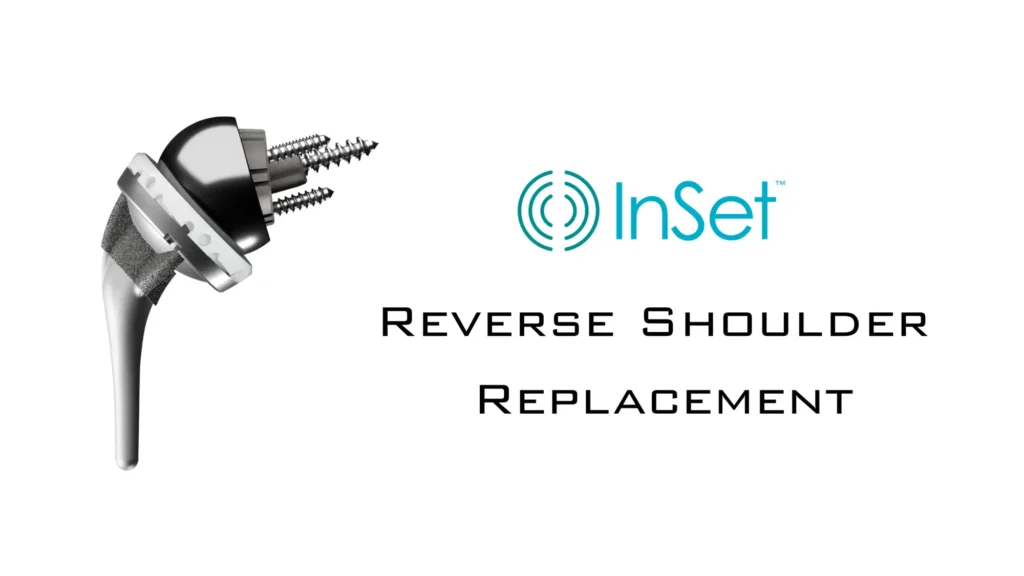 InSet™ Reverse Shoulder Replacement
