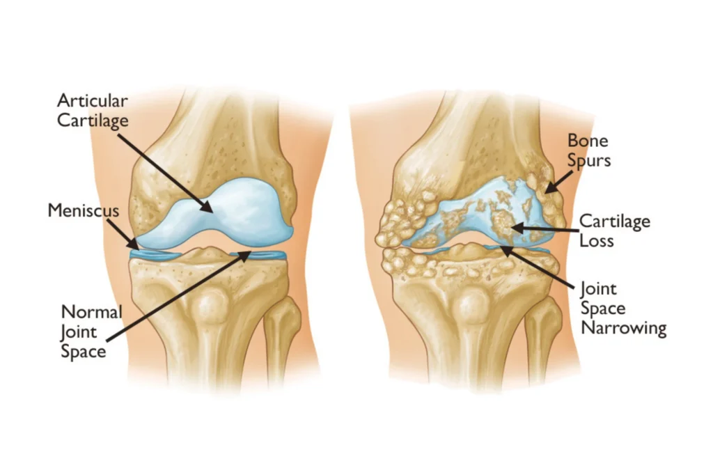 Osteoarthritis