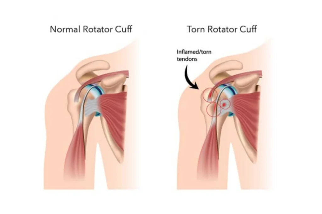 Rotator cuff tear, normal rotator cuff