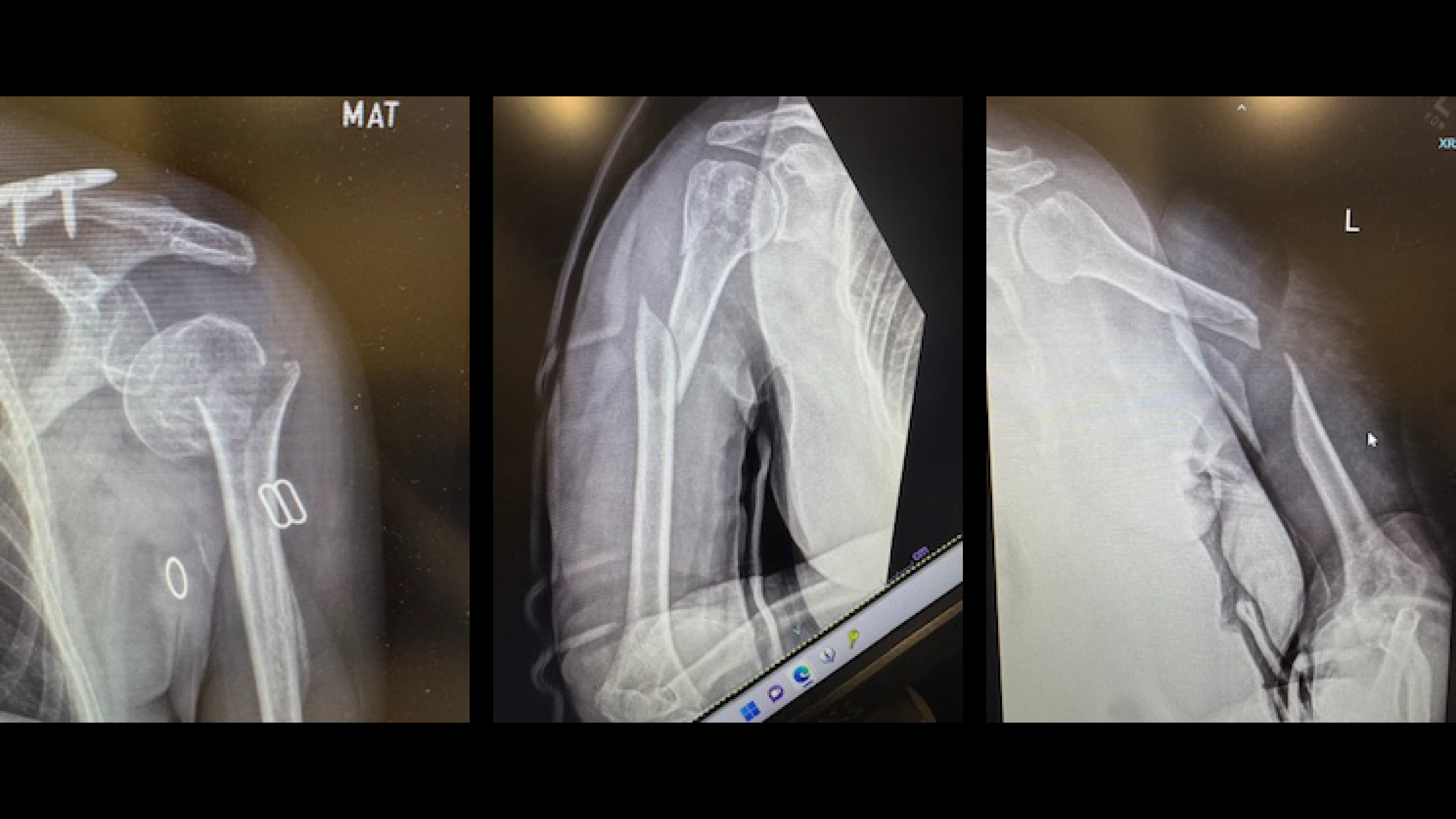 X-Rays_Humeral Fracture