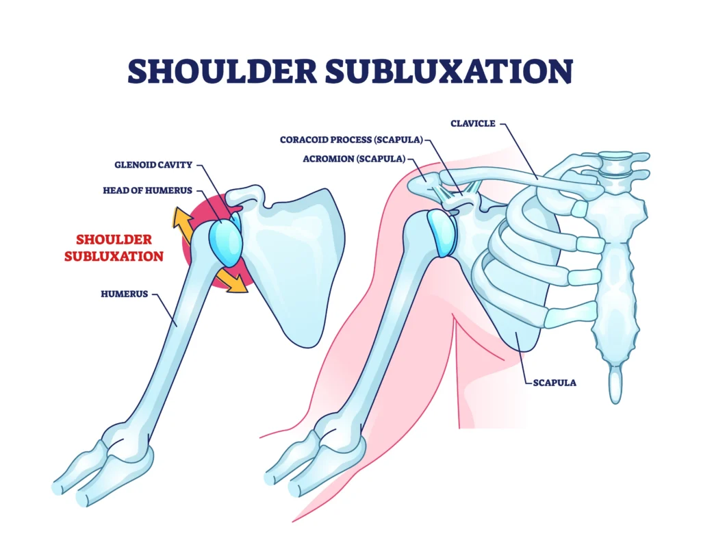 A diagram of a shoulder, comparing a healthy shoulder anatomy to that of a shoulder with subluxation.