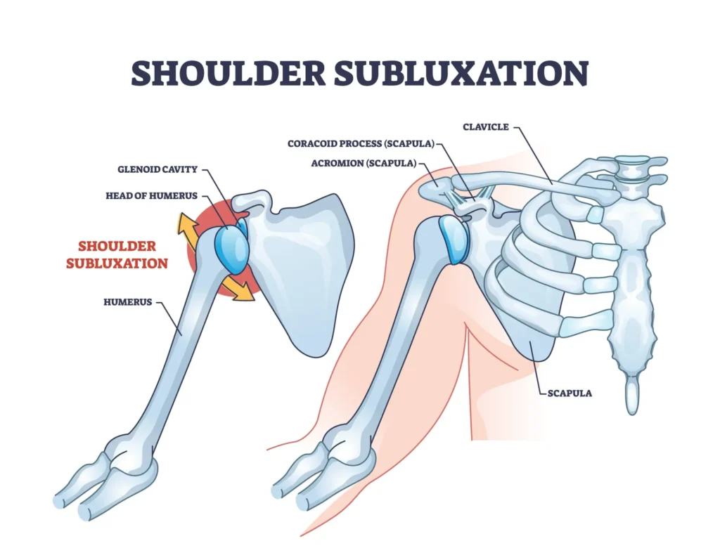 shoulder subluxation diagram A diagram of a shoulder, comparing a healthy shoulder anatomy to that of a shoulder with subluxation.