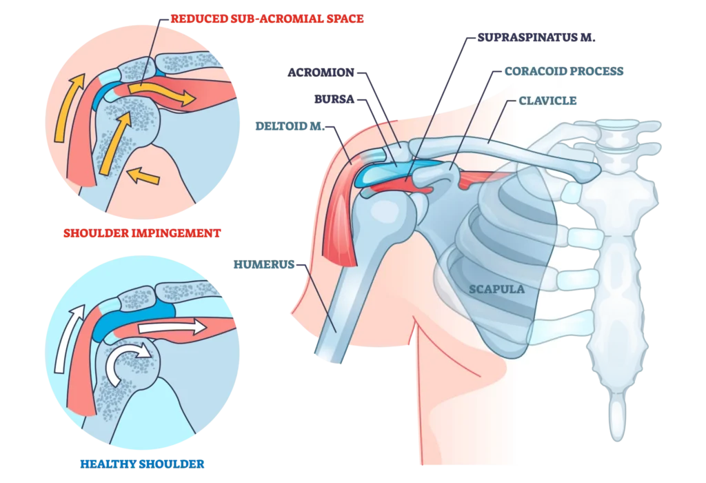 shoulder impingement diagram.