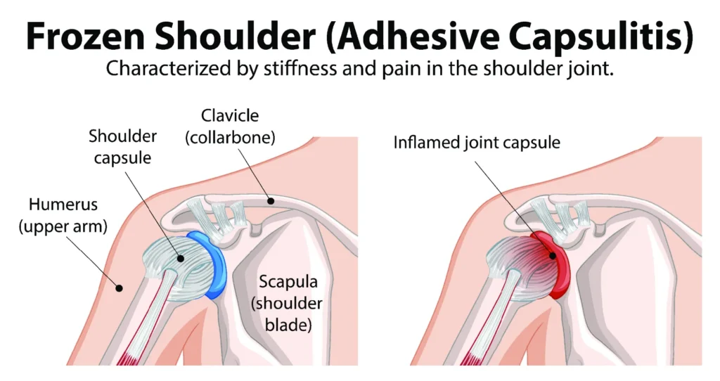 frozen shoulder diagram showing a normal shoulder capsule and an inflamed joint capsule.