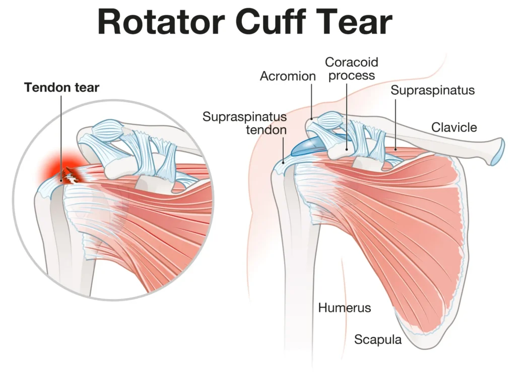 rotator cuff tear diagram.