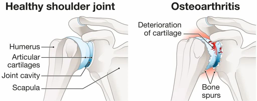 Osteoarthritis vs. Healthy shoulder comparison 